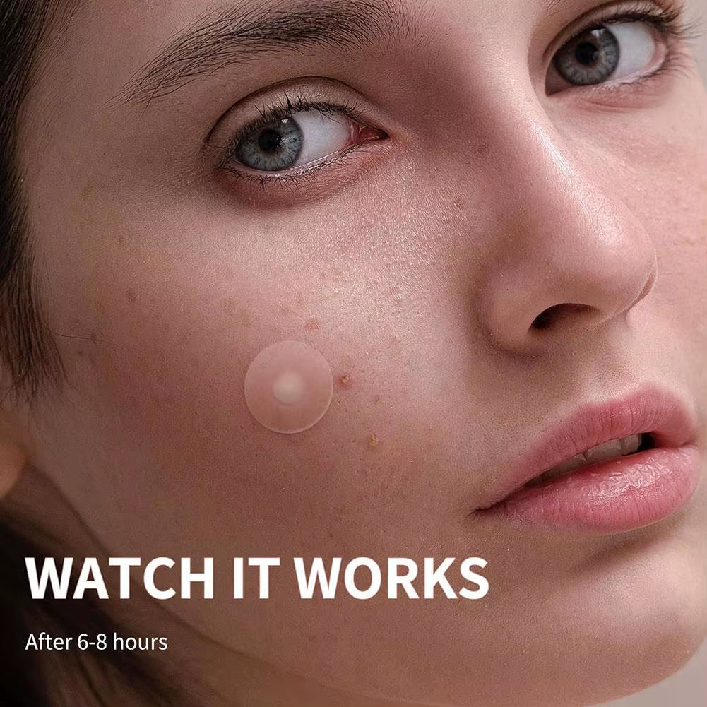 Invisible Acne Patches – Hydrocolloid Spot Stickers